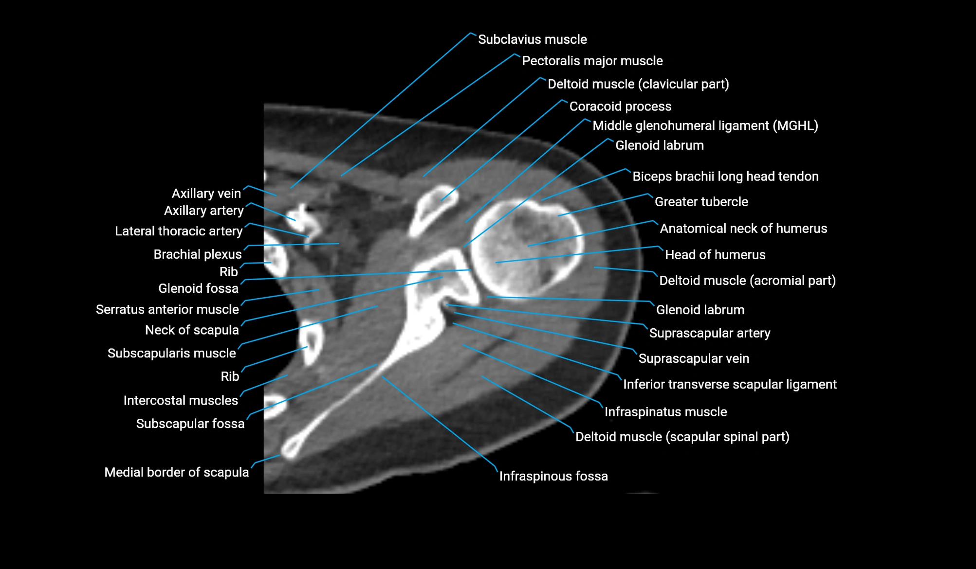 CT upper arm axial  cross sectional anatomy labelled radiology image -00086.webp